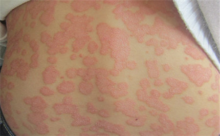 电脑辐射对银屑病患者病情有影响吗