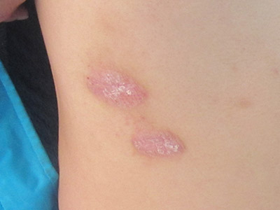 土方治疗银屑病效果好吗