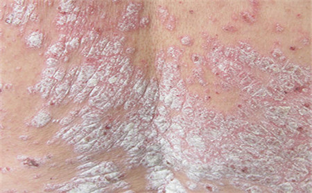 身上长银屑病的危害
