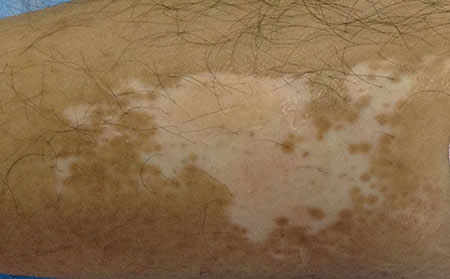 白癜风患者该如何饮食呢