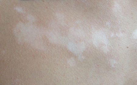 白癜风患者饮食注意事项