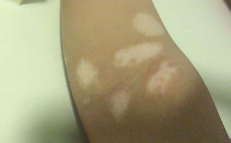 白癜风患者饮食吃对了吗