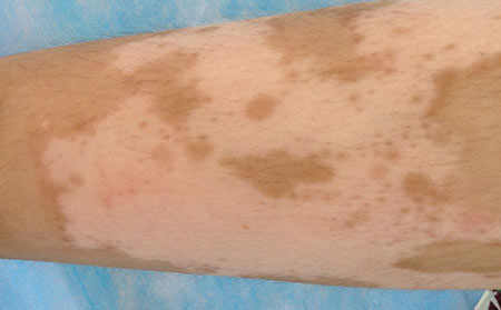 哺乳期白癜风患者如何吃水果