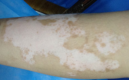 儿童患上白癜风患者自闭怎么办