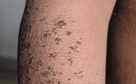 鱼鳞病患者怎么吃