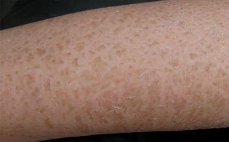 皮炎患者可以吃蝎子吗