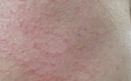 皮炎患者可以吃石榴吗