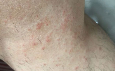 适合皮炎患者的运动有哪些