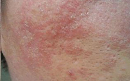 皮炎患者身上瘙痒怎么办