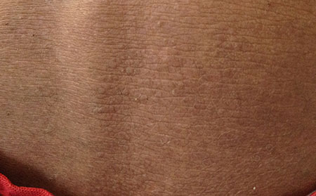 长湿疹该怎么护理