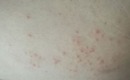 湿疹是怎么影响患者的