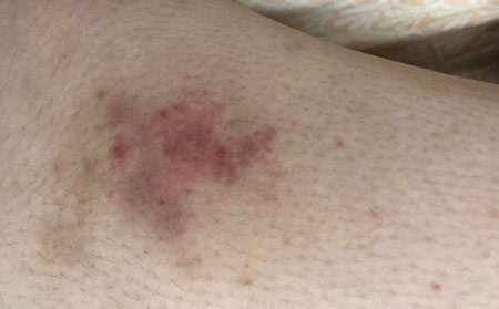 湿疹患者可以染发吗