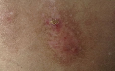 不恰当治疗湿疹的危害