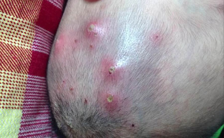 潍坊毛囊炎治疗措施头皮毛囊炎