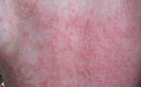 潍坊湿疹治疗花多少钱冬季湿疹