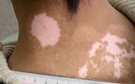 白癜风去潍坊哪治疗好白癜风会扩散吗