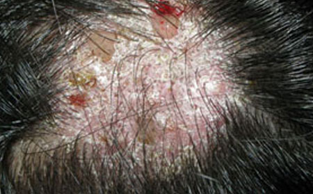 潍坊治头癣医院哪家好得头癣怎样治