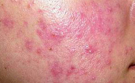 潍坊哪家治痤疮医院好面部痤疮症状表现