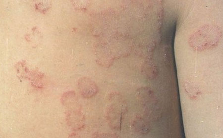 潍坊体癣能不能治疗好宝宝得体癣怎样治