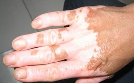 潍坊白癜风医院哪家好怎样治白癜风