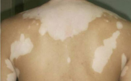 白癜风症状表现,白癜风症状扩散吗