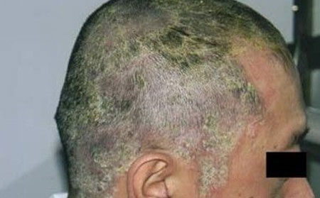 头癣症状表现,头癣症状图片