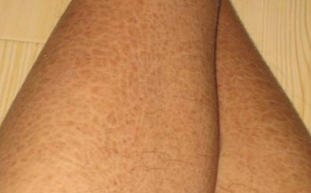 早期鱼鳞病症状,早期鱼鳞病痒吗