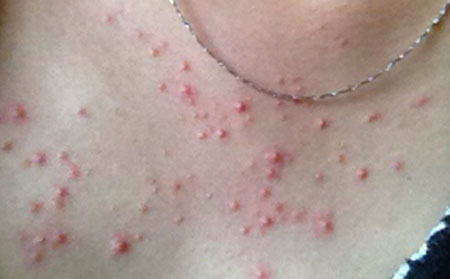 毛囊炎症状表现,有毛囊炎什么症状