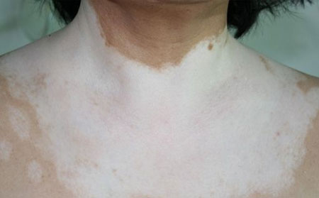 怎样确诊白癜风症状,怎样判断得了白癜风