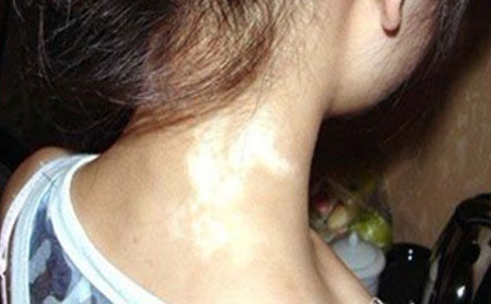 白癜风病因,白癜风发病原因