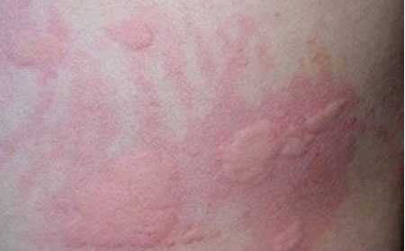 荨麻疹会加重吗,荨麻疹严重会怎样