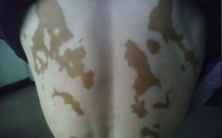 白癜风好转表现,白癜风快好什么样