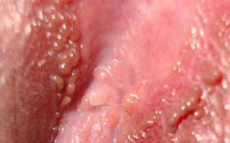 带状疱疹怎么办,得带状疱疹要怎么办