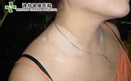 女性白癜风病因,女性更年期白癜风