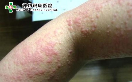 荨麻疹的护理,护理荨麻疹的方法