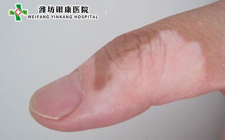 白斑症状什么表现,白癜风症状表现