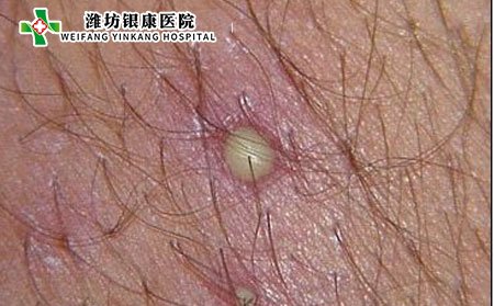 背部毛囊炎用药,背部毛囊炎治疗