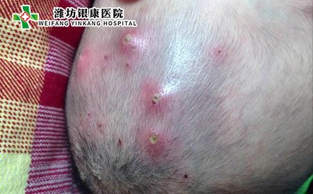 头部毛囊炎,头发毛囊炎