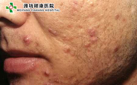 痤疮和痘痘区别,痤疮常识