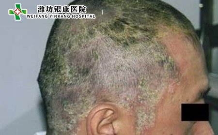 有头癣可以染发吗,有头癣可以烫发吗