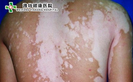 青少年白癜风护理,怎样护理青少年白癜风