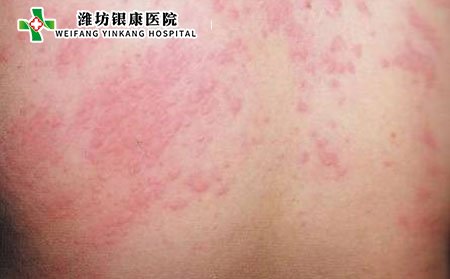 皮炎症状,常见皮炎症状表现