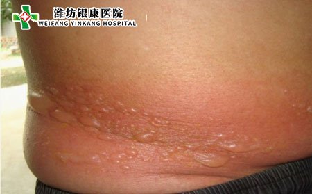 带状疱疹症状,怎样确诊带状疱疹