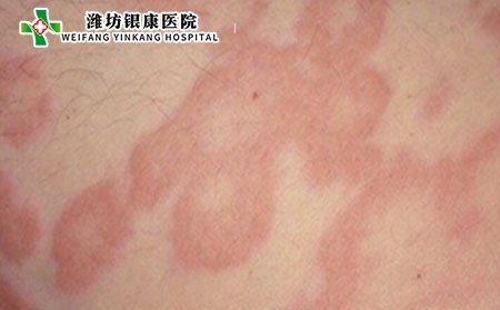 儿童皮炎治疗,怎样治儿童皮炎