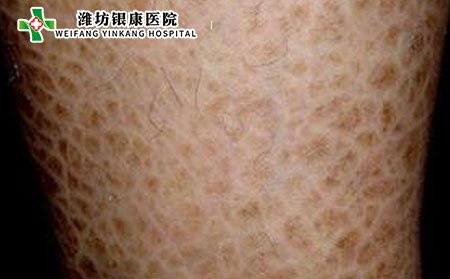 幼儿鱼鳞病症状,幼儿鱼鳞病什么样
