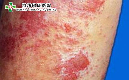 荨麻疹,孩子荨麻疹怎么办