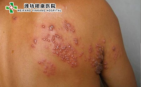 带状疱疹,带状疱疹会传染吗