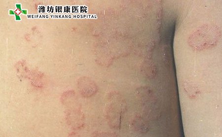 体癣症状,儿童体癣什么症状