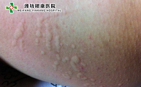 皮肤过敏,皮肤过敏遗传吗,皮肤过敏治疗