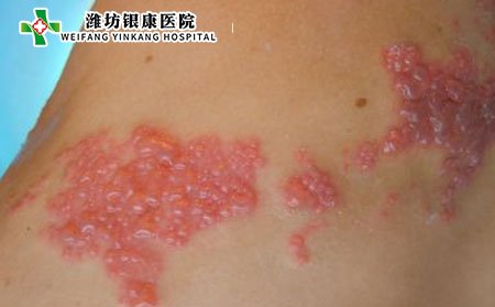 疱疹,疱疹是什么病,疱疹严重吗